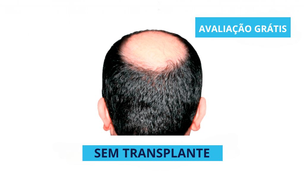 SEM TRANSPLANTE