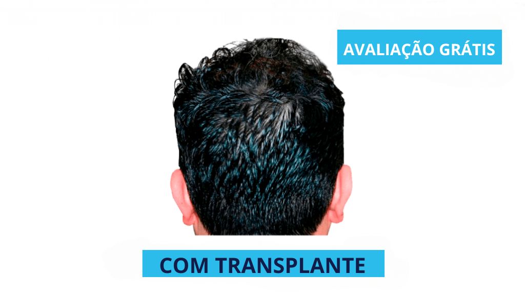 Quanto custa um implante capilar? Qual o preço médio no Brasil? - Faz  Capital